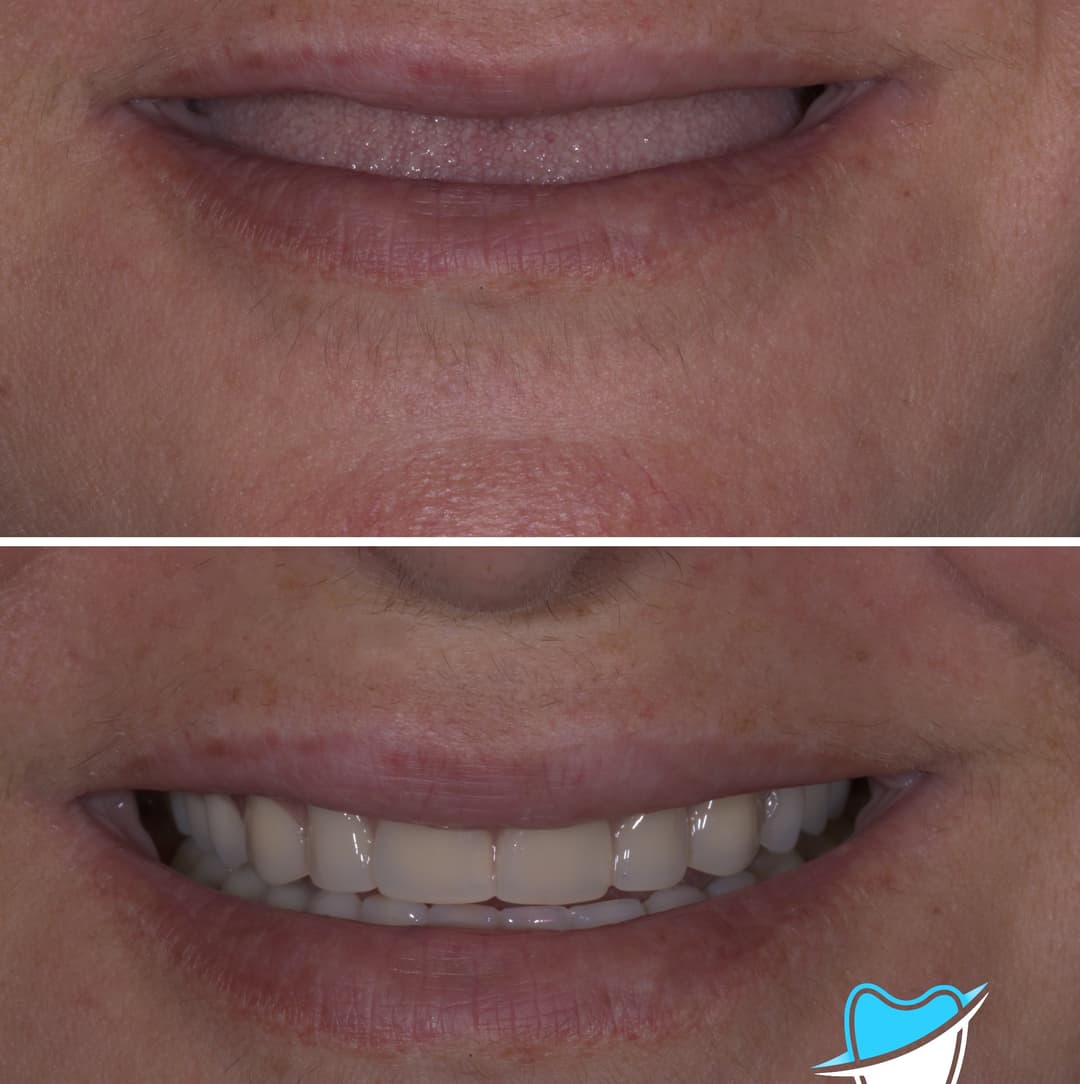 Dentures aren't obsolete just yet.