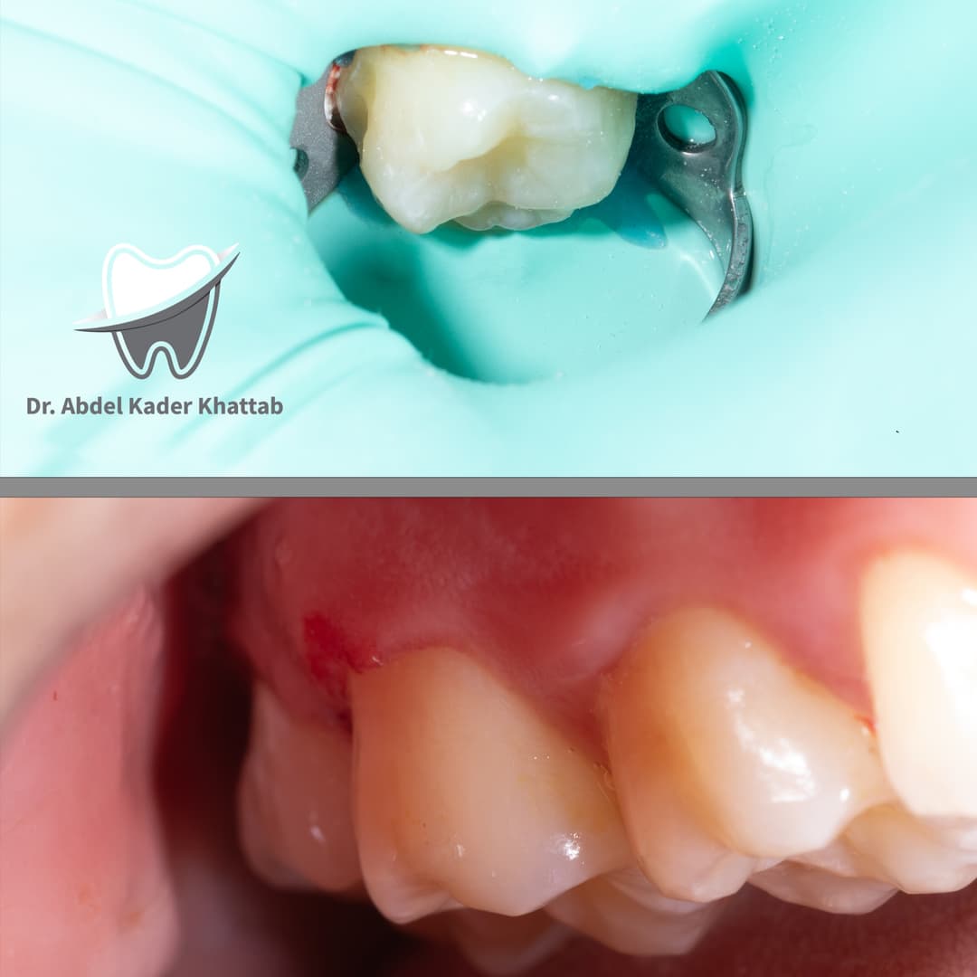 Upper Molar Class V Restoration.
