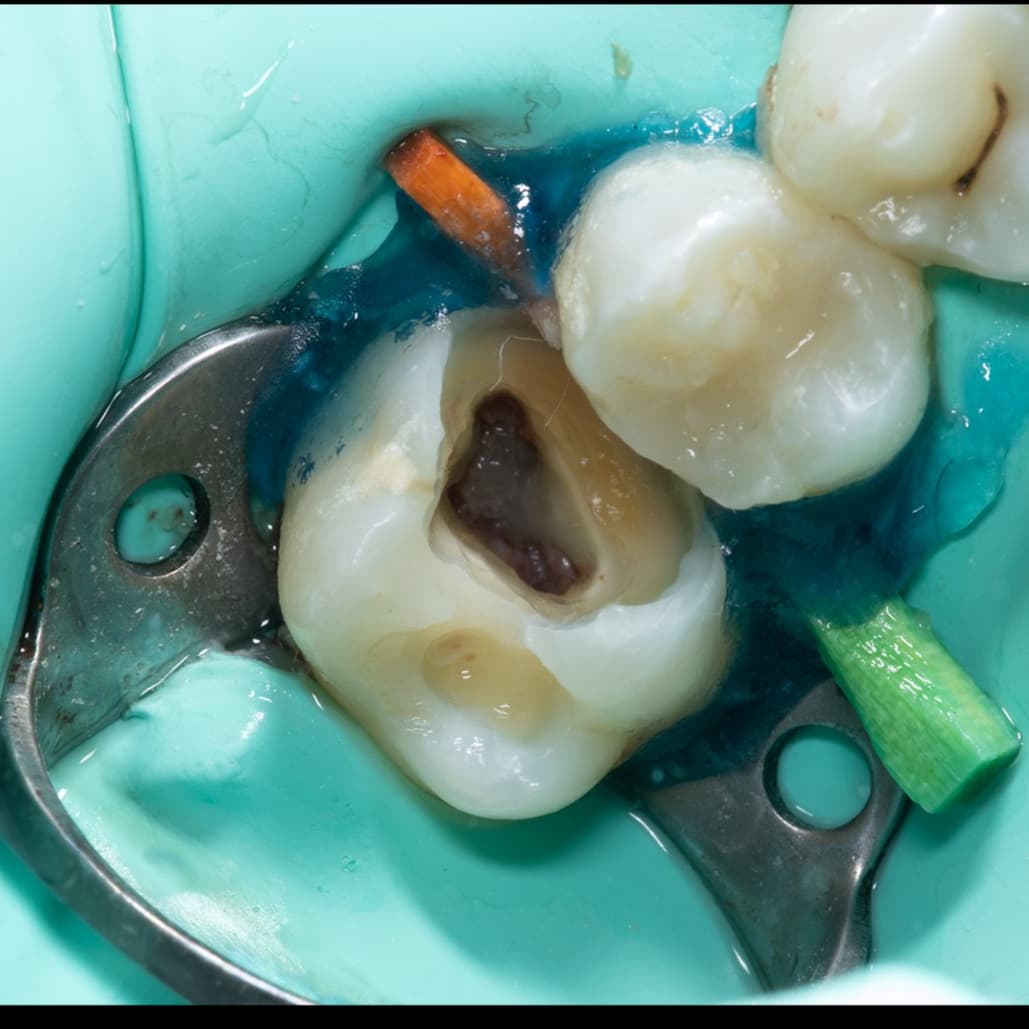 Pulpotomy and Class II Composite on Upper Permanent Molar.