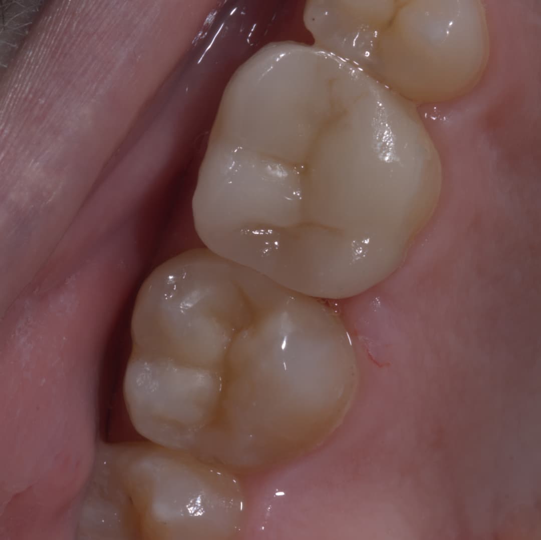 Overlay and Composite on Endo Treated Teeth