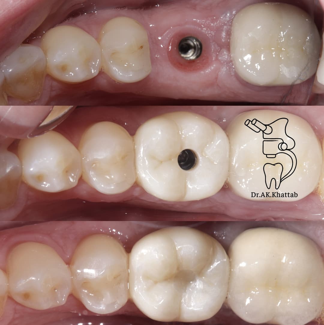 Crown Over Implant