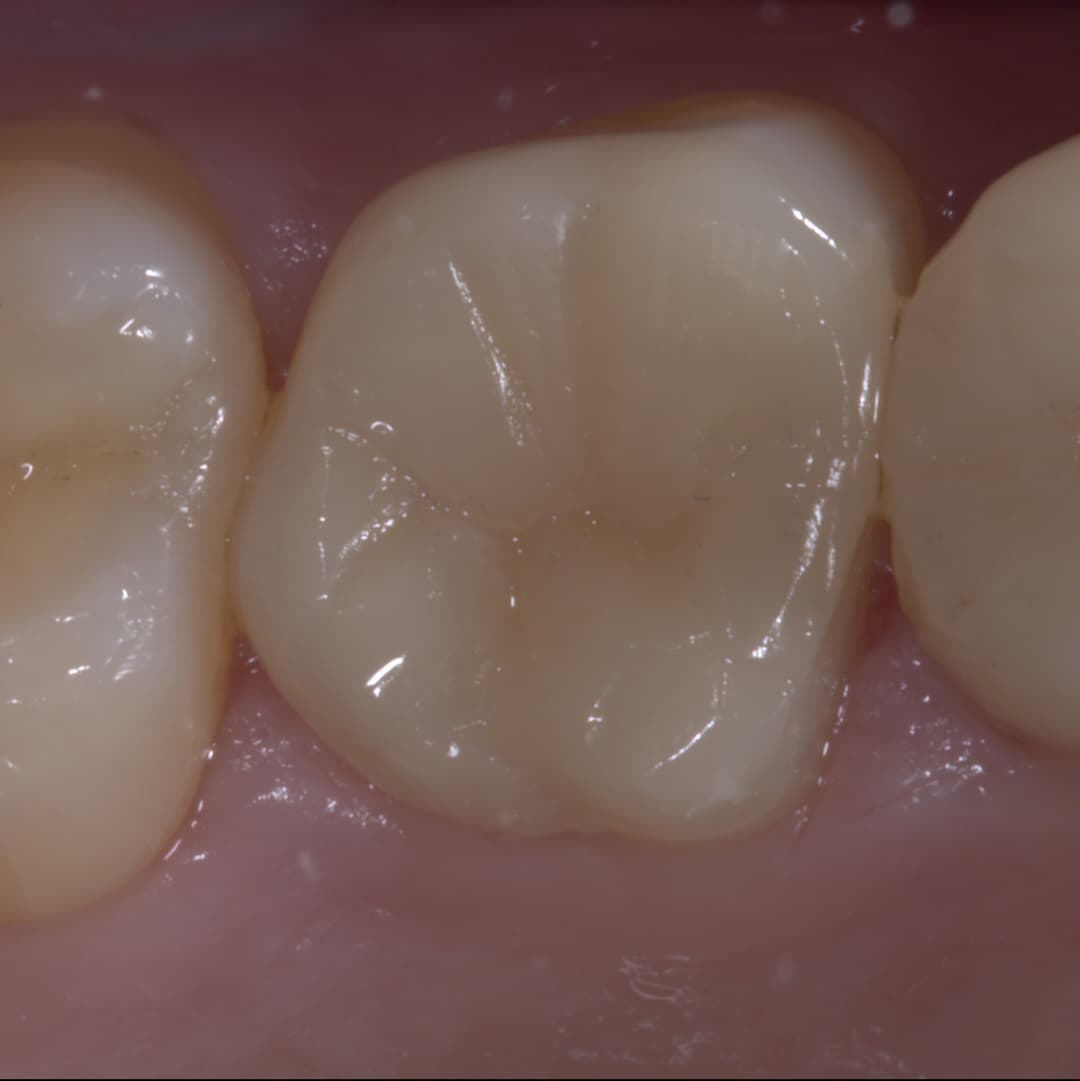 Direct overlay as a long term temporary.