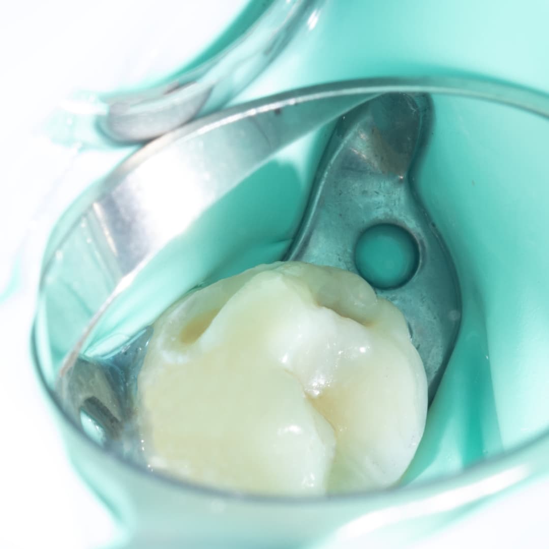 Upper Molar Distobuccal Cavity Isolation