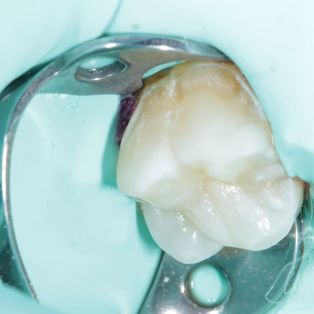 Class V on upper molar.