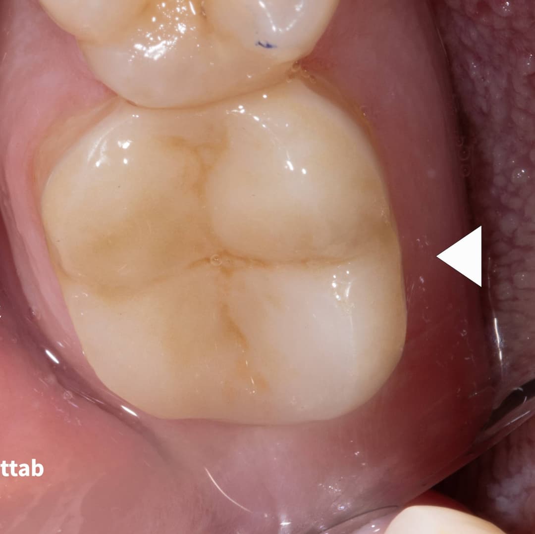 Overlay on Cracked Lower Second Molar.