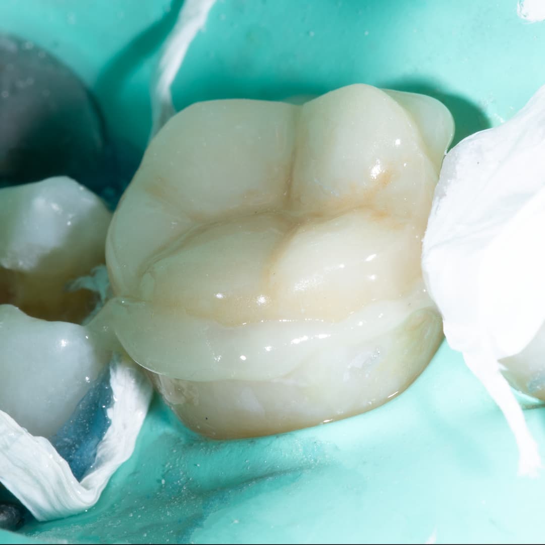 Overlay on Lower First Molar